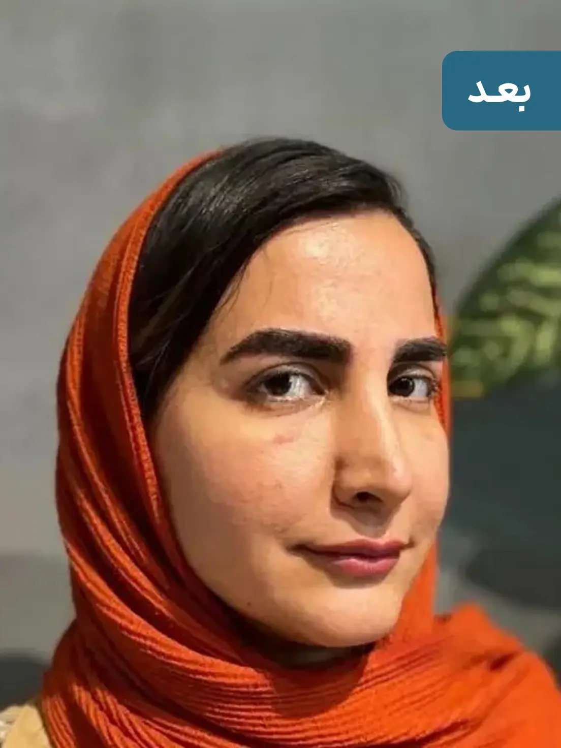 کاشت ابرو