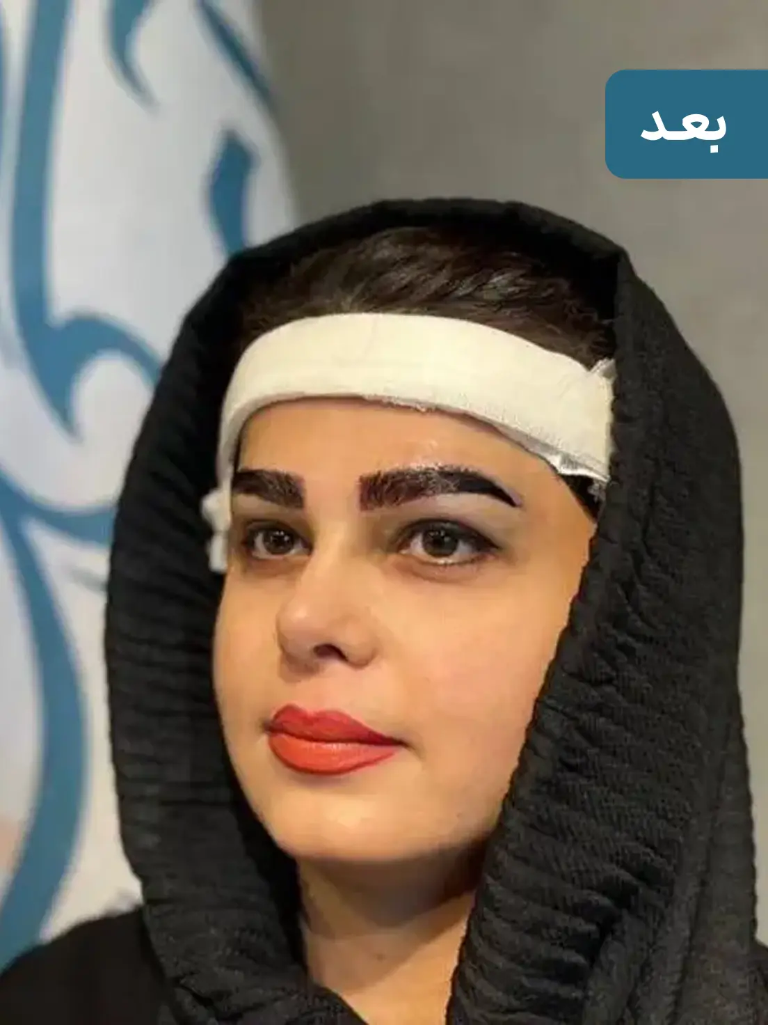 کاشت ابرو