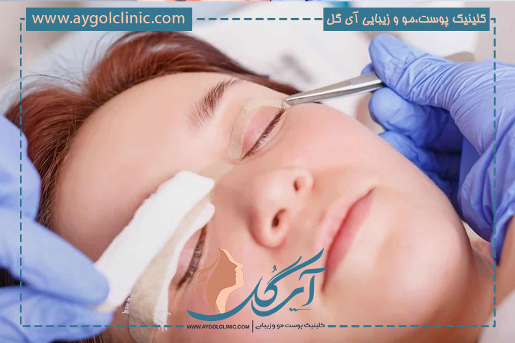 بلفاروپلاستی
