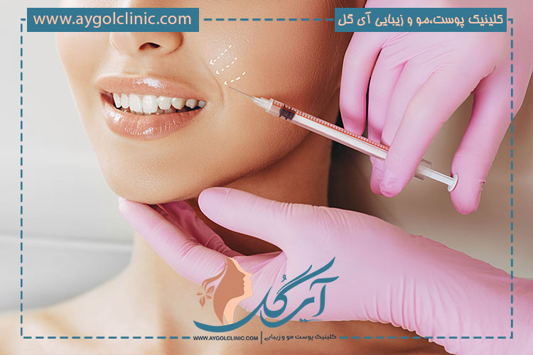 تزریق-فیلر-خط-خنده