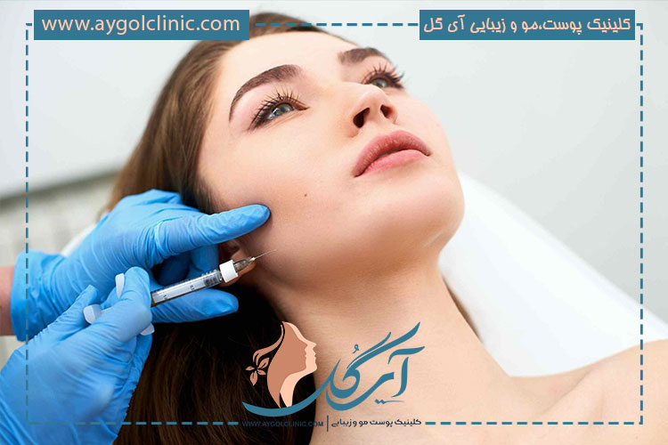 فیلر-الانسه