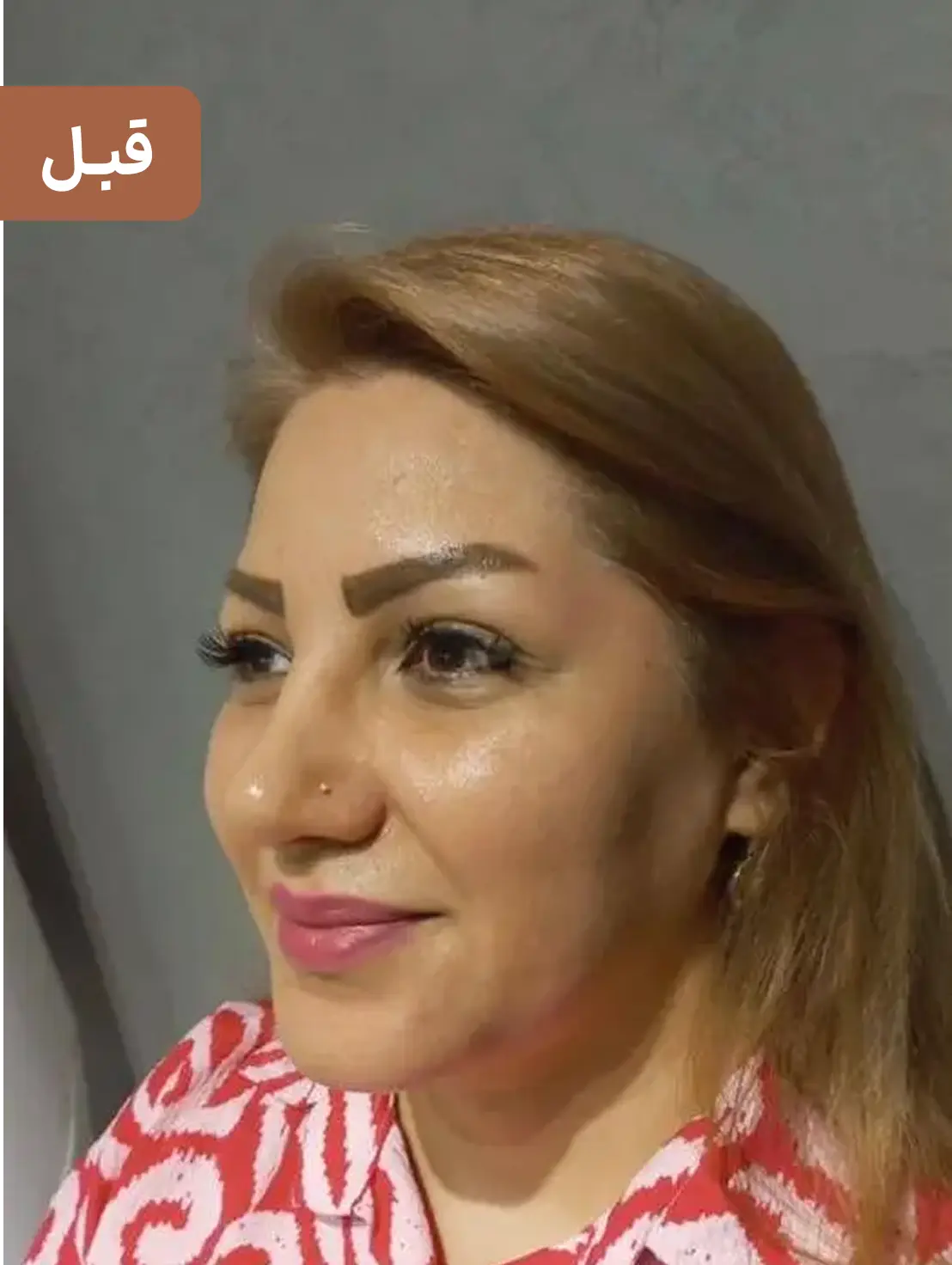 بلفاروپلاستی