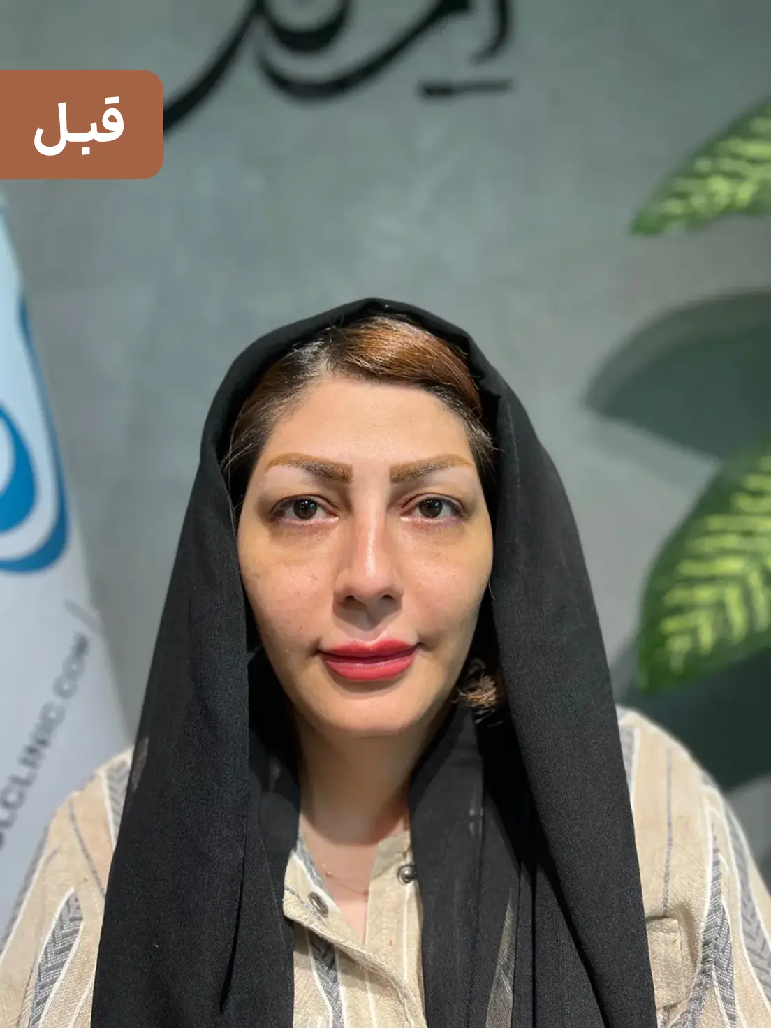 بلفاروپلاستی
