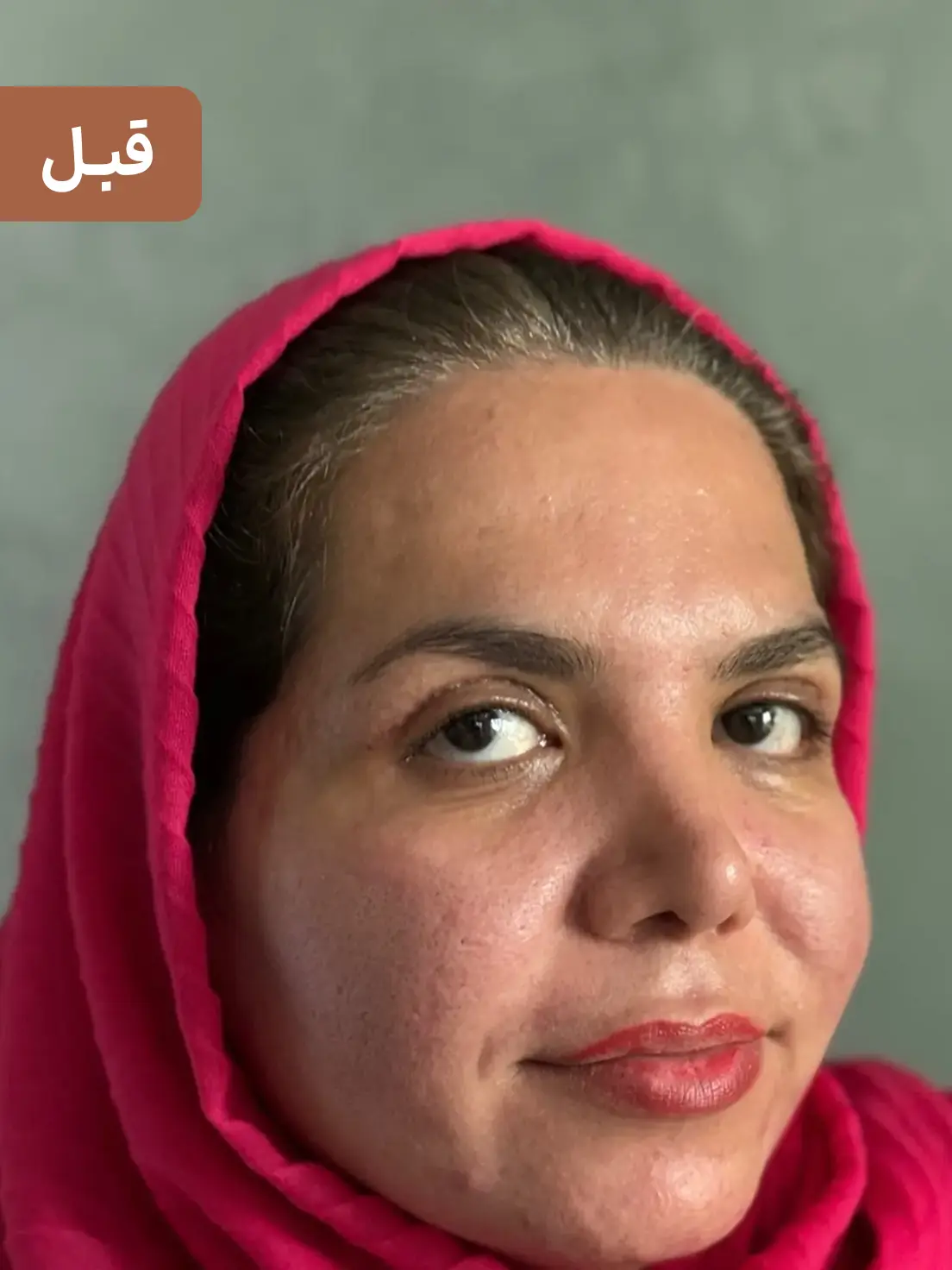 بلفاروپلاستی