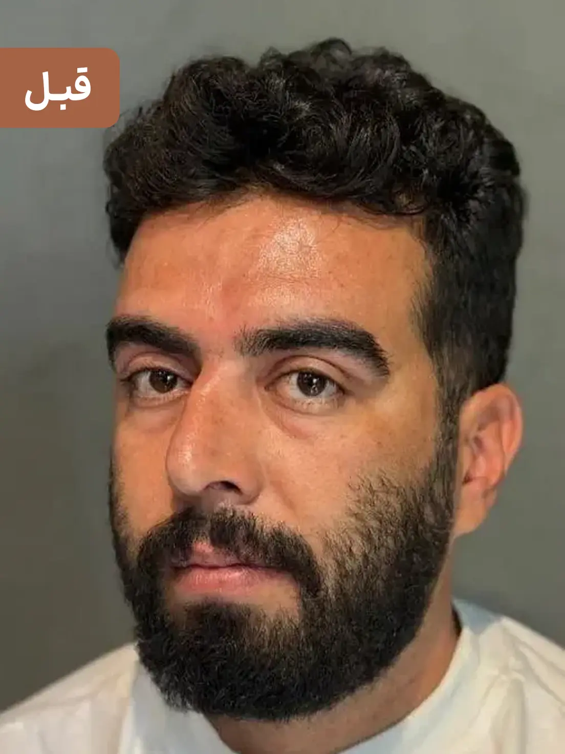 بلفاروپلاستی