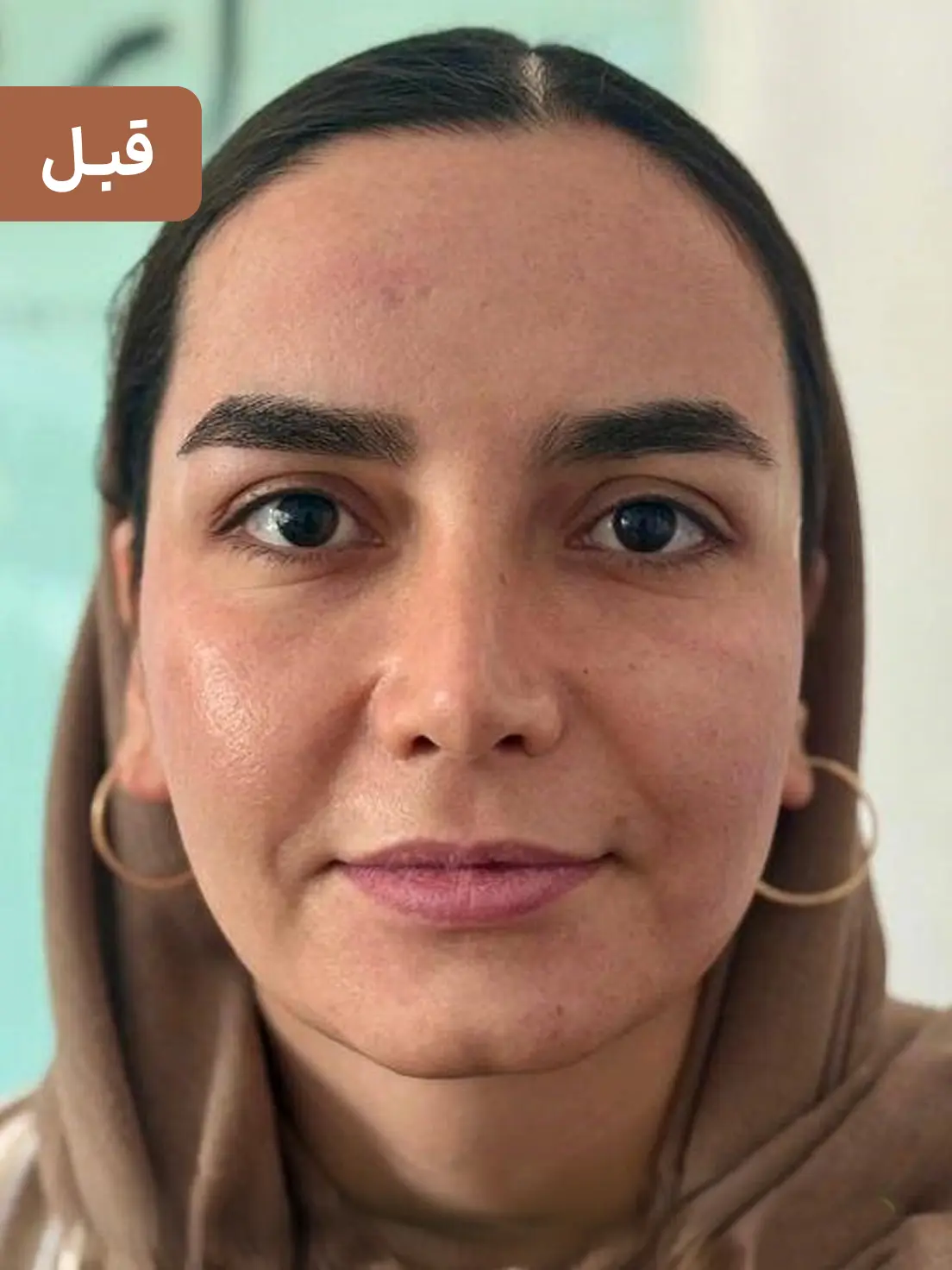 فیلر خط خنده ارزان برای رفع چروک اطراف لب + نتیجه ماندگار 🌸