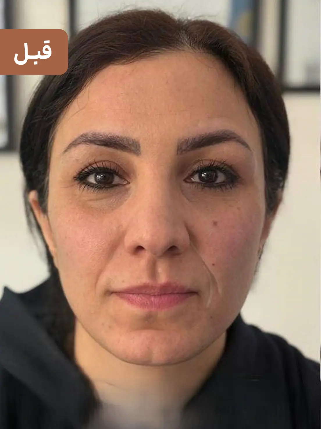 فیلر خط خنده ارزان برای رفع چروک اطراف لب + نتیجه ماندگار 🌸