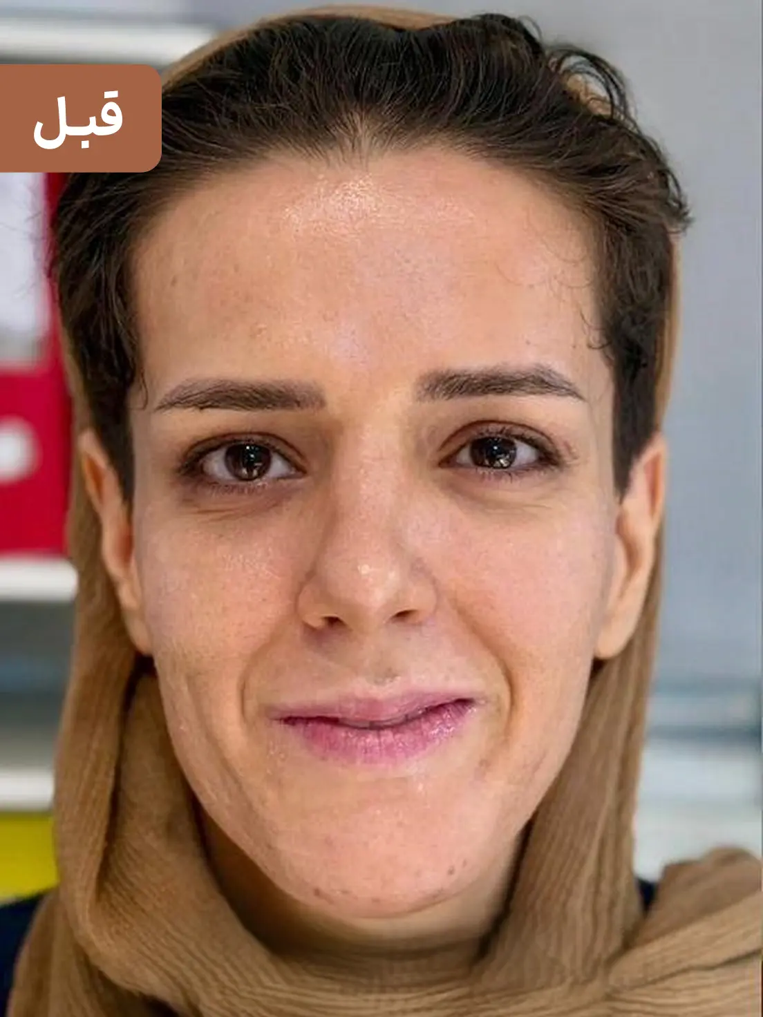 فیلر خط خنده ارزان برای رفع چروک اطراف لب + نتیجه ماندگار 🌸