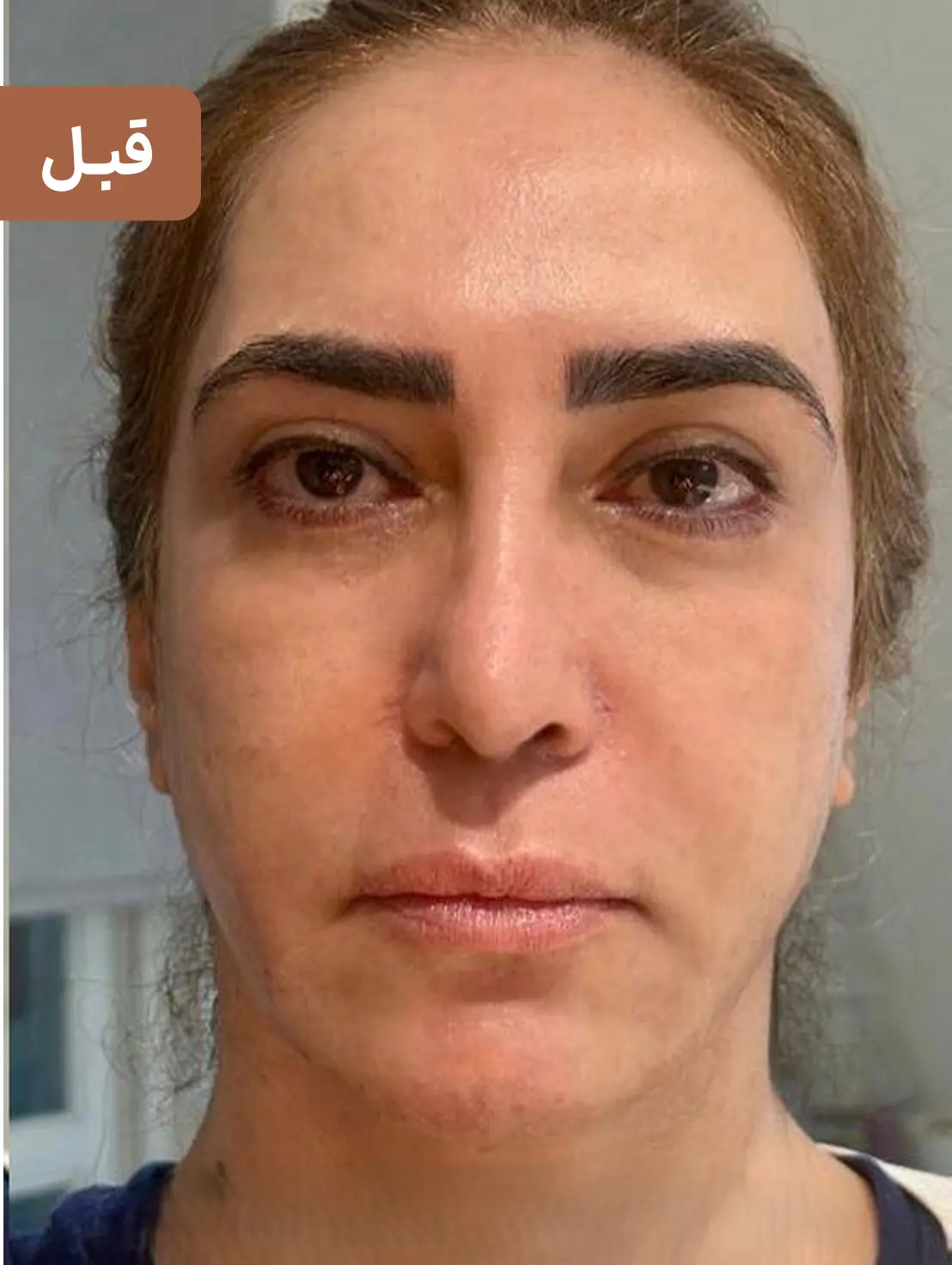 فیلر خط خنده ارزان برای رفع چروک اطراف لب + نتیجه ماندگار 🌸