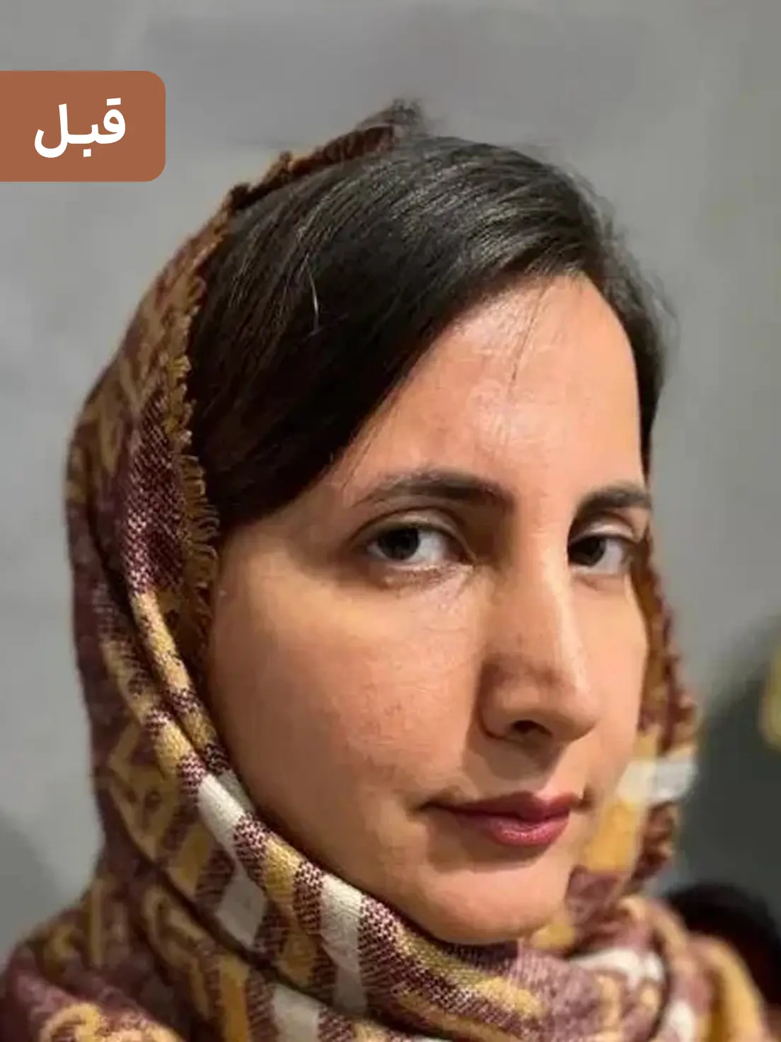 کاشت ابرو