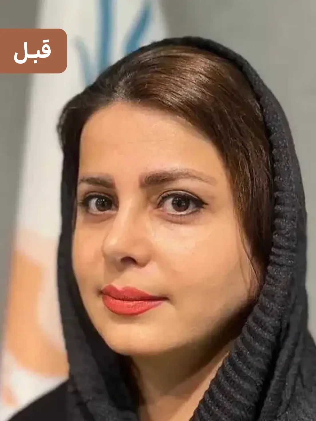 کاشت ابرو
