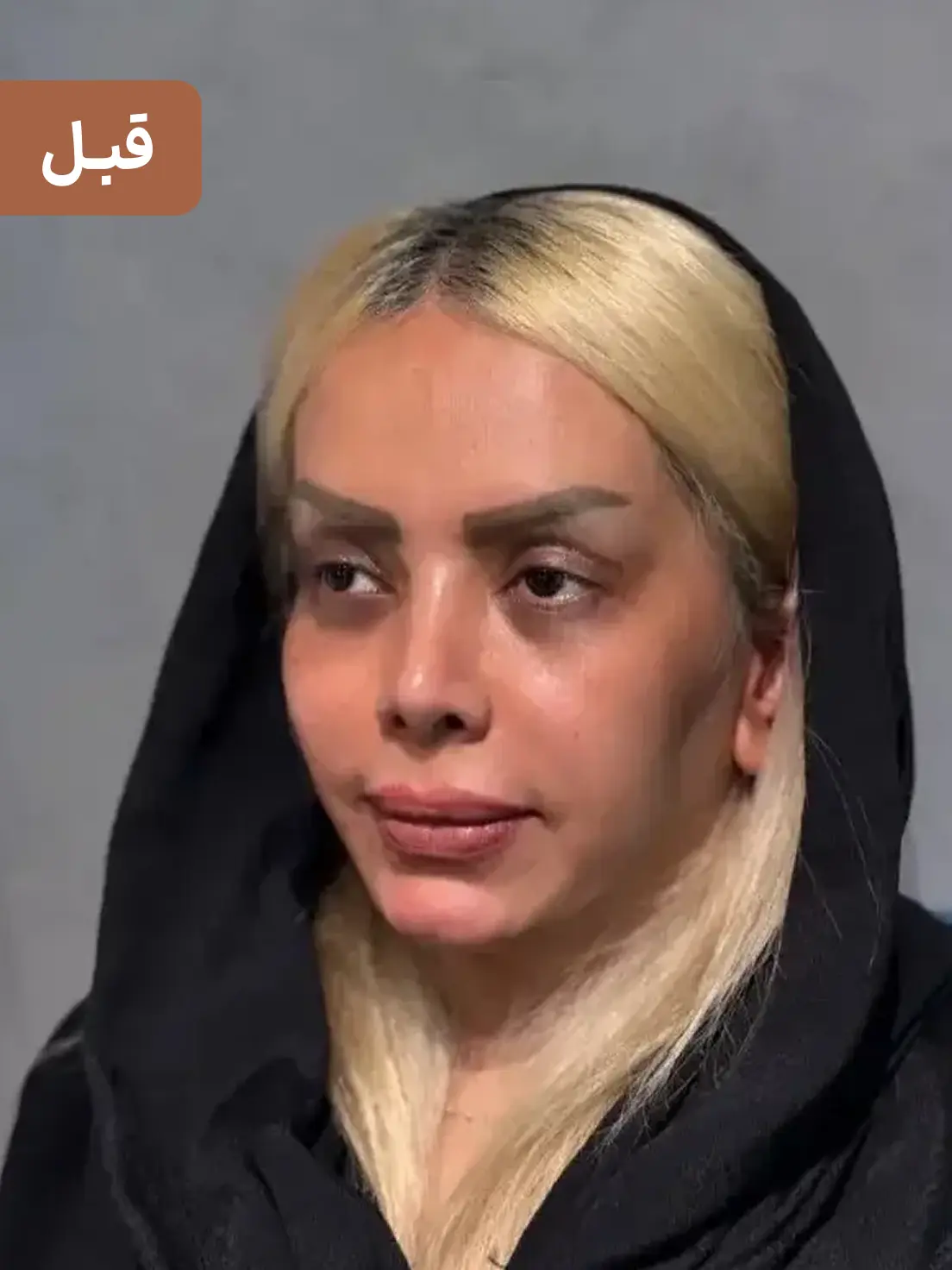 کاشت ابرو