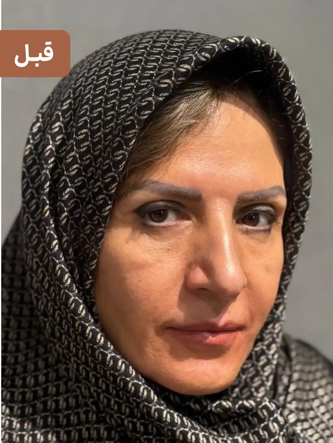 کاشت ابرو