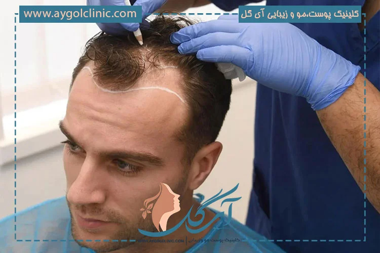 کاشت-مو