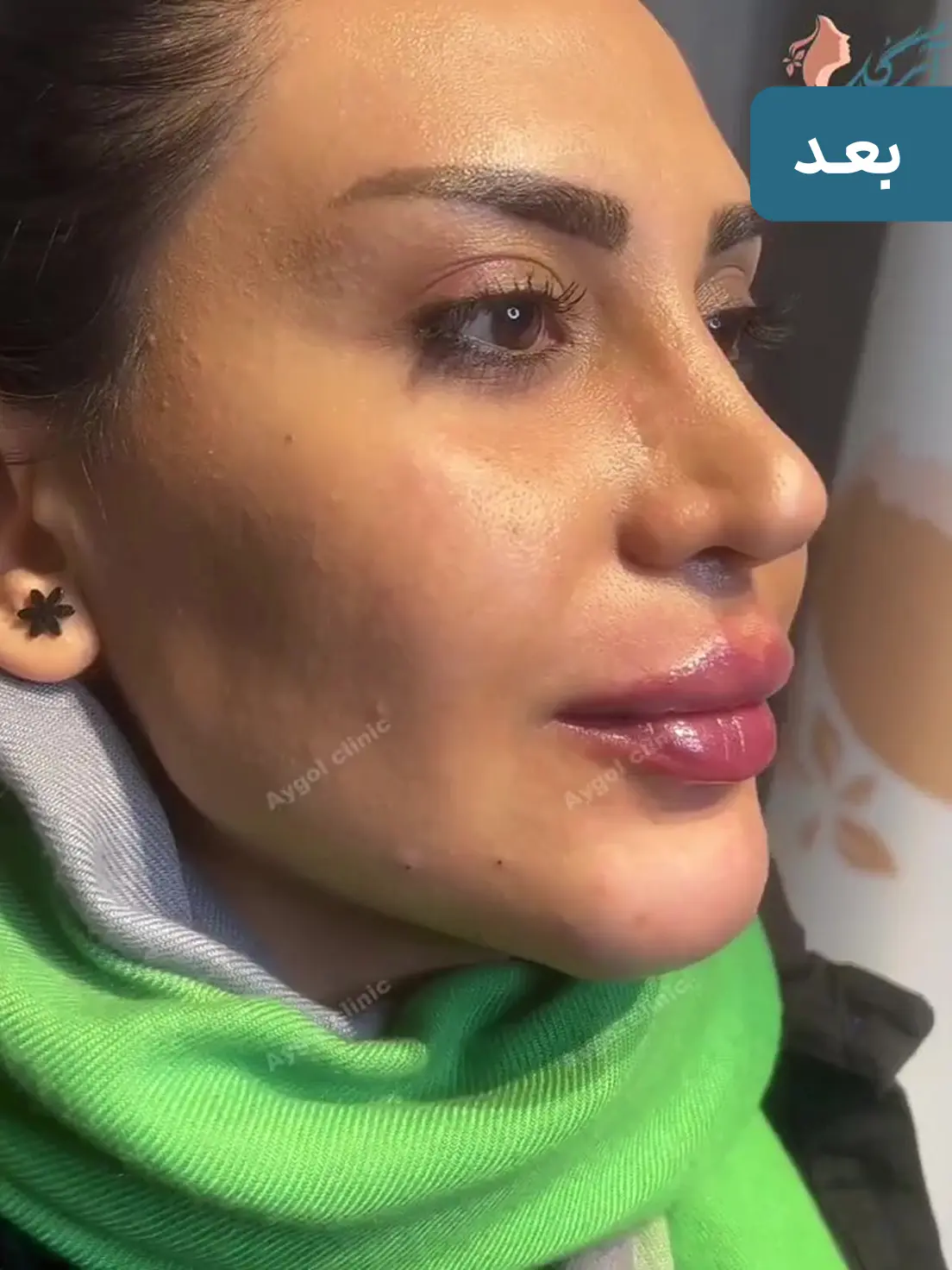 بعد زاویه سازی فک و چانه