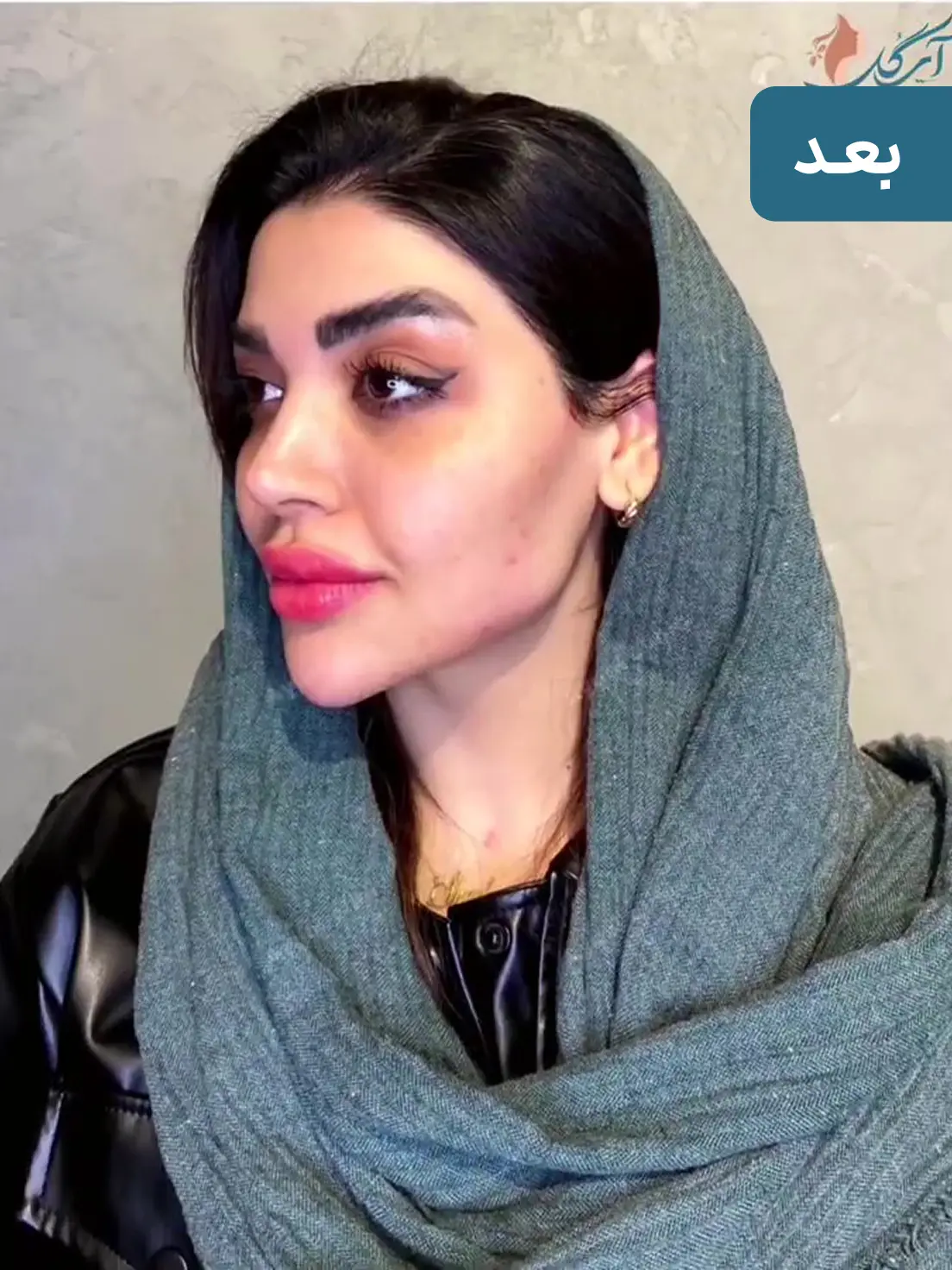 بعد زاویه سازی فک و چانه