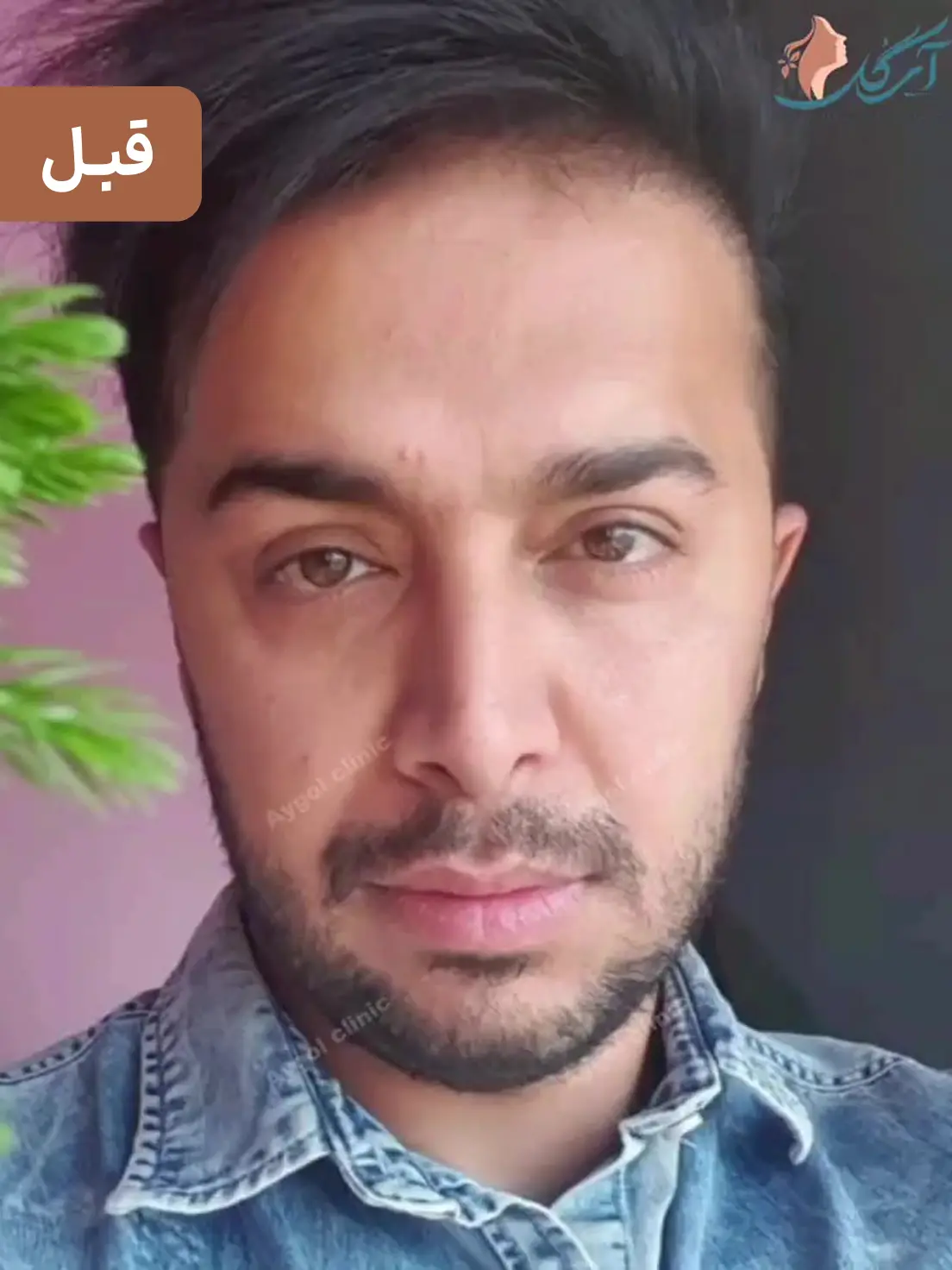 قبل زاویه سازی فک و چانه