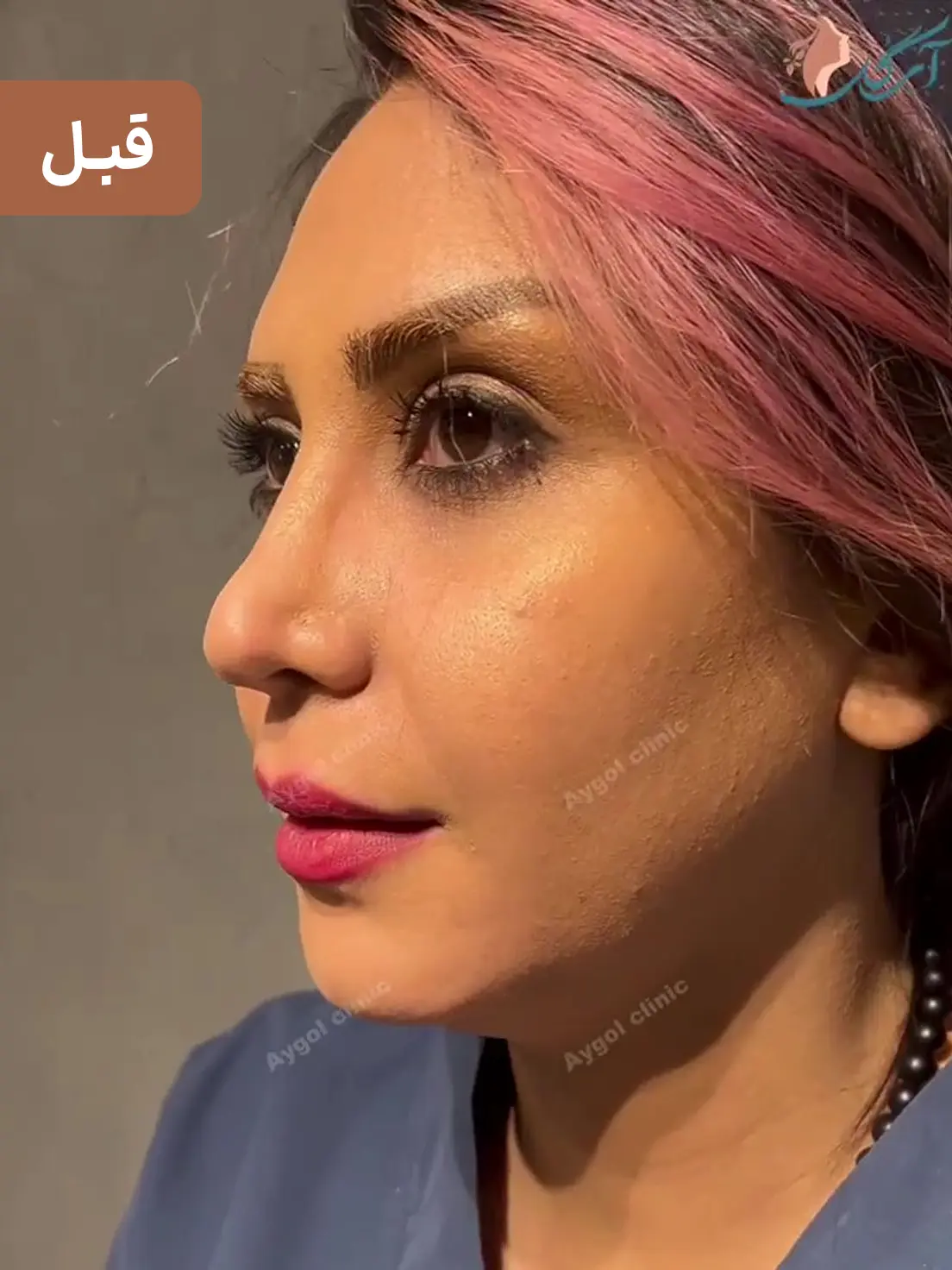قبل زاویه سازی فک و چانه