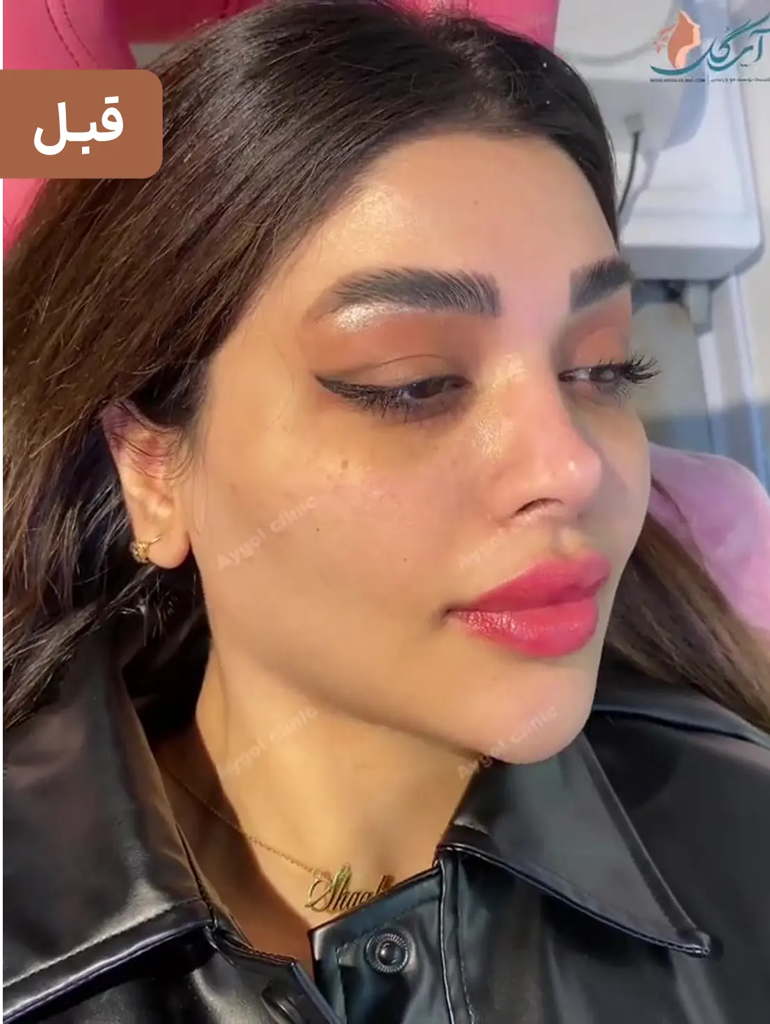 قبل زاویه سازی فک و چانه