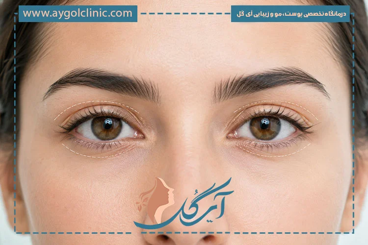 مشکلات قابل اصلاح برای بلفاروپلاستی چهار پلک بالا و پایین