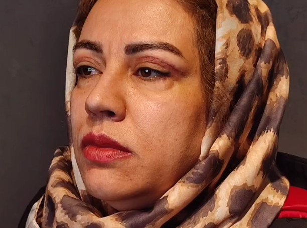 نمونه کار بلفاروپلاستی