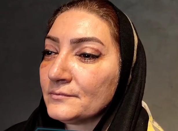 نمونه کار بلفاروپلاستی