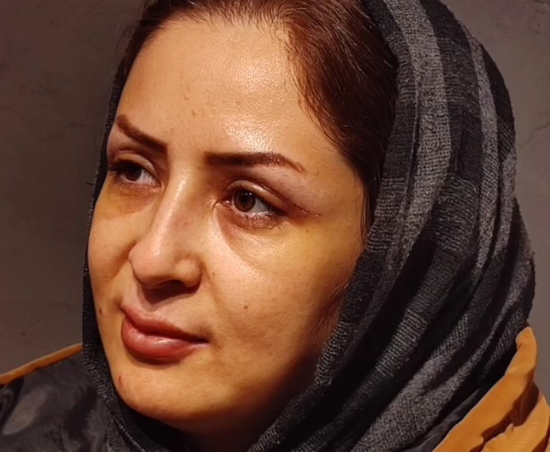 نمونه کار بلفاروپلاستی
