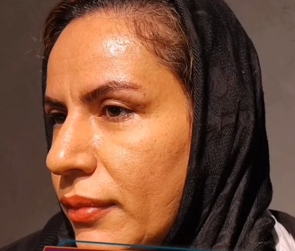نمونه کار بلفاروپلاستی