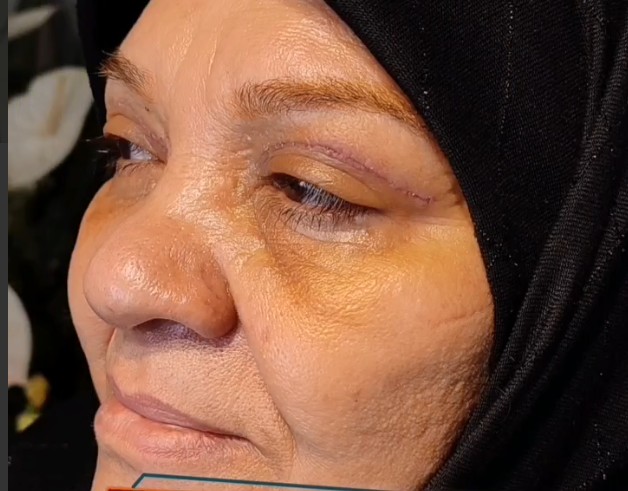 نمونه کار بلفاروپلاستی