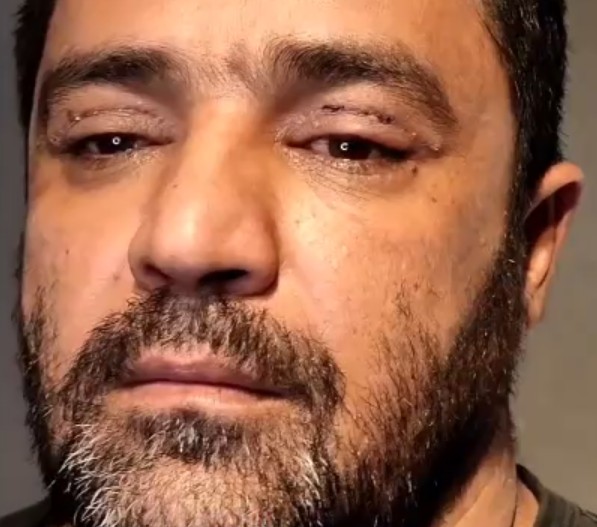 نمونه کار بلفاروپلاستی