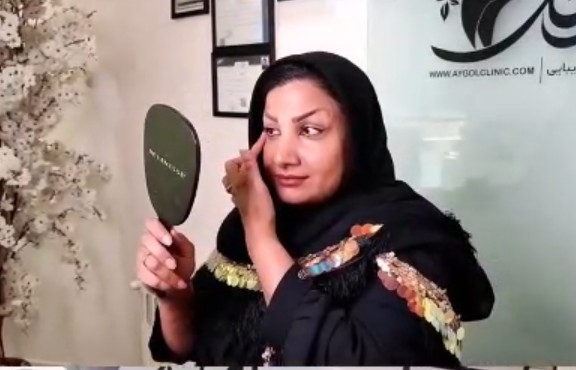 نمونه کار بلفاروپلاستی