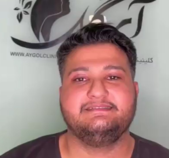 نمونه کار بلفاروپلاستی
