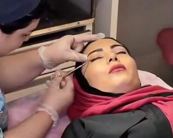 نمونه کار بلفاروپلاستی