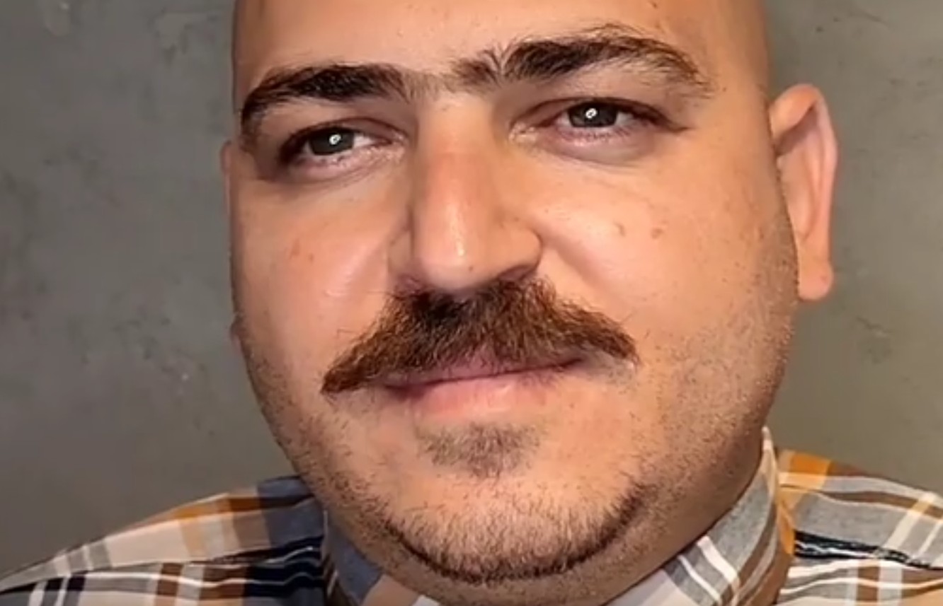 نمونه کار بلفاروپلاستی