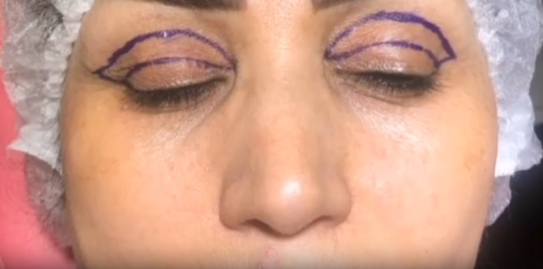 نمونه کار بلفاروپلاستی