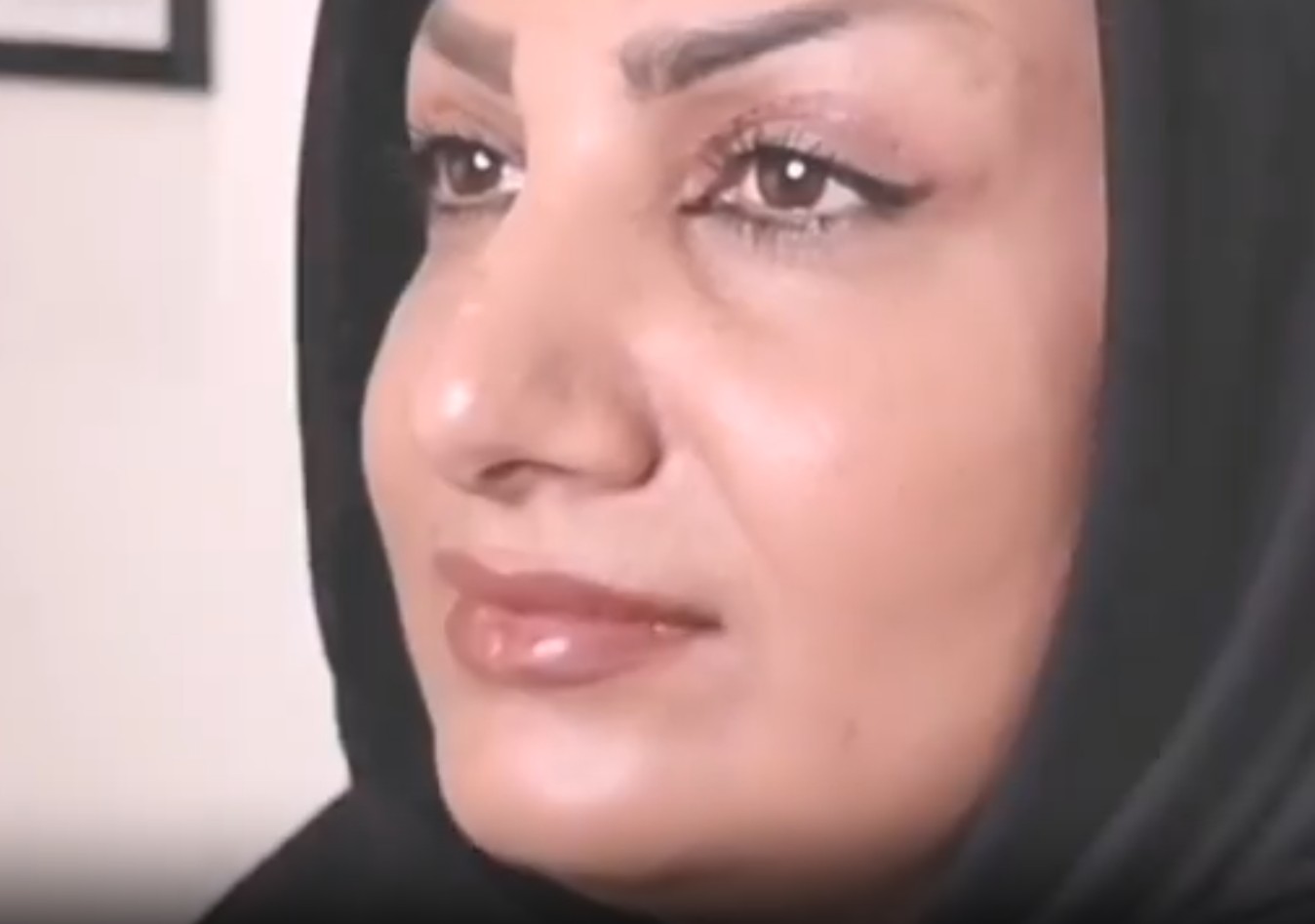 نمونه کار بلفاروپلاستی