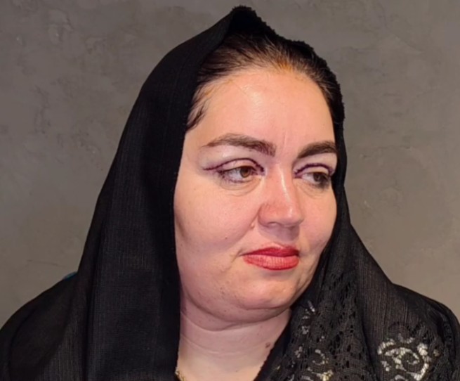 نمونه کار بلفاروپلاستی