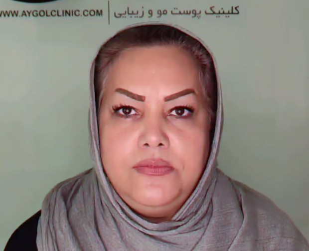 نمونه کار بلفاروپلاستی