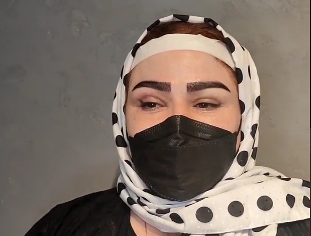 نمونه کار بلفاروپلاستی