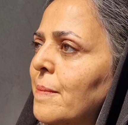نمونه کار بلفاروپلاستی