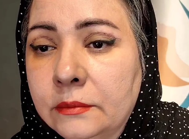 نمونه کار بلفاروپلاستی