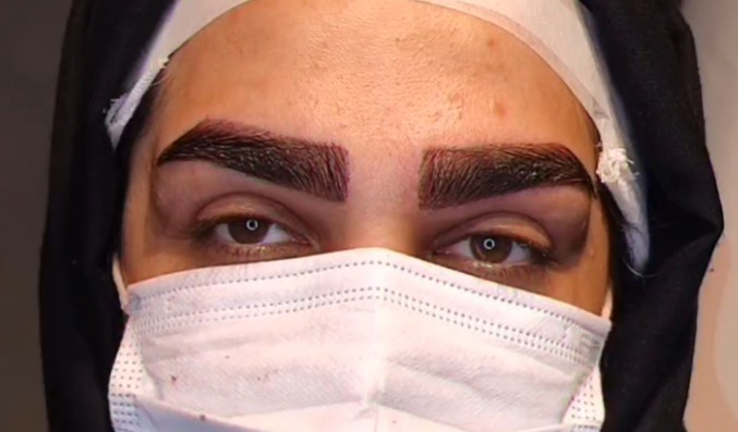 نمونه کار کاشت ابرو در کلینیک آی گل