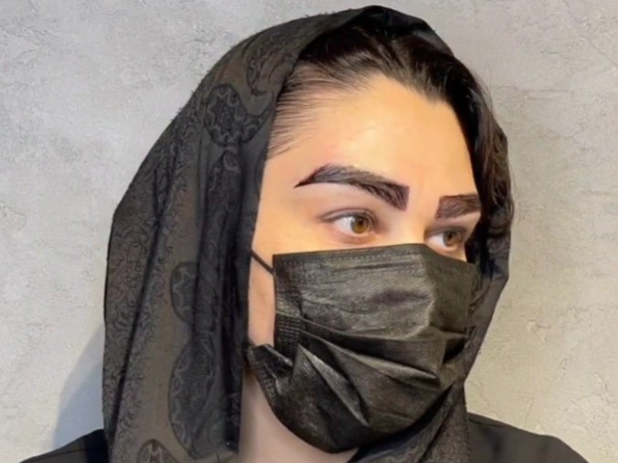 نمونه کار کاشت ابرو در کلینیک آی گل