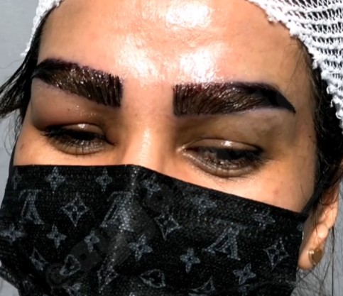 نمونه کار کاشت ابرو در کلینیک آی گل