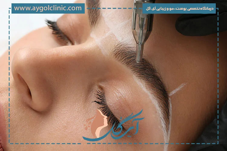 کاشت ابرو در 30 سالگی با طراحی طبیعی و متناسب با فرم چهره