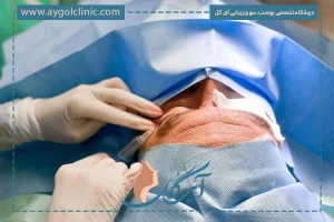 مقایسه بلفاروپلاستی با بی حسی یا بیهوشی | کدام انتخاب بهتری است؟