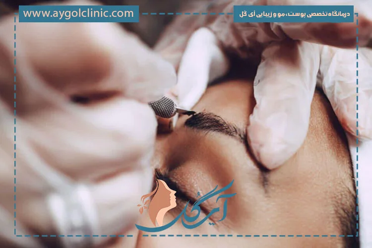مهم‌ترین فرق میکرو کاشت با کاشت ابرو