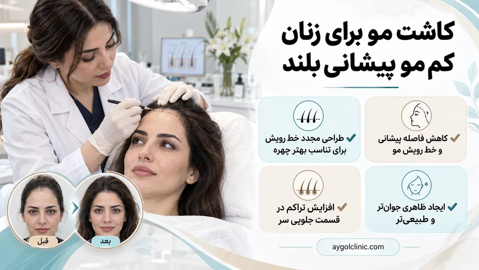 نحوه کاشت مو برای زنان کم بو پیشانی بلند