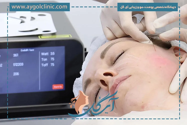 مراقبت‌های بعد از اندولیفت در دوران نقاهت